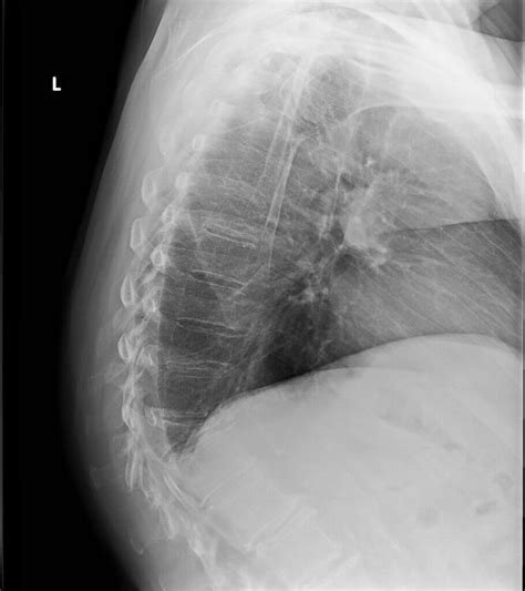 thoracic compression test|do thoracic compression fractures heal.